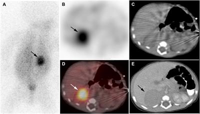 Clinical utility of nuclear imaging in the evaluation of pediatric adrenal neoplasms